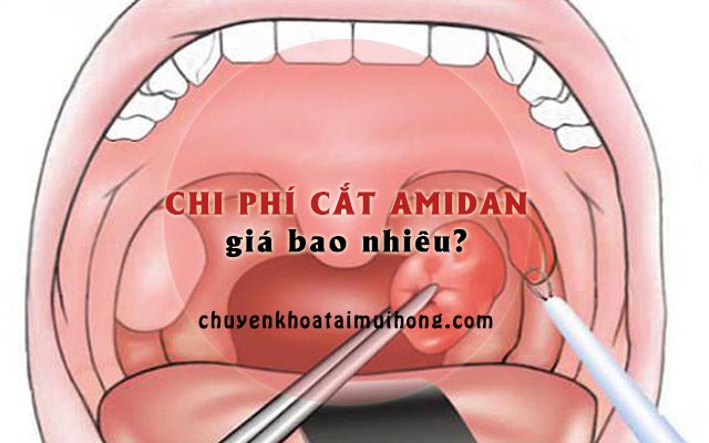 Chi phí cắt amidan giá bao nhiêu tiền