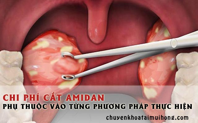 Chi phí cắt amidan phụ thuộc vào từng phương pháp 