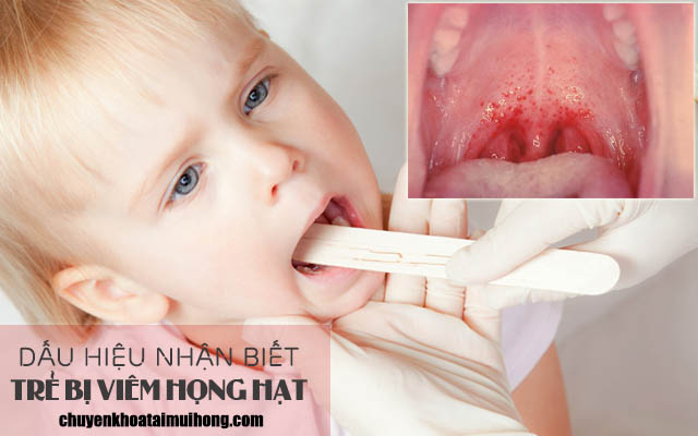 Dấu hiệu nhận biết bệnh viêm họng hạt ở trẻ