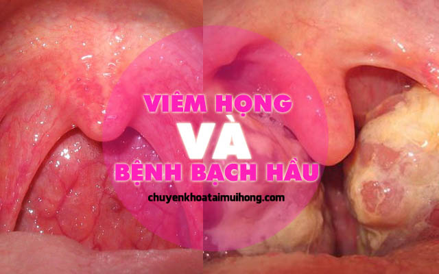 Đừng nhầm lẫn giữa viêm họng và bệnh bạch hầu