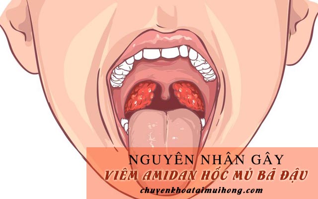 Nguyên nhân gây viêm amidan hốc mủ bã đậu