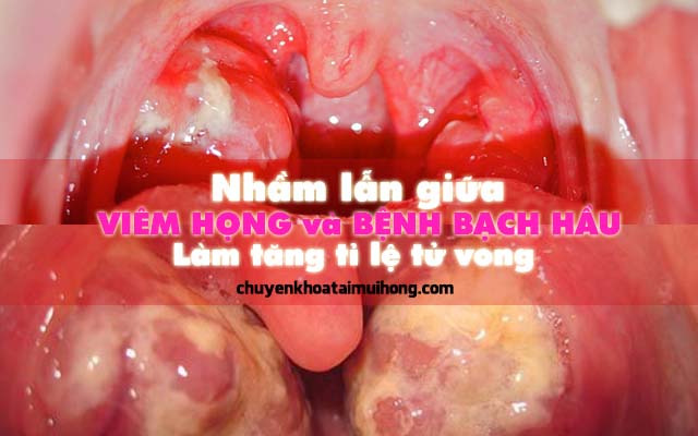 Nhầm lẫn giữa viêm họng và bệnh bạch hầu làm gia tăng tỉ lệ bệnh nhân tử vong