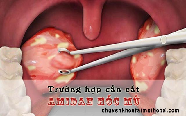 Trường hợp cần cắt viêm amidan hốc mủ