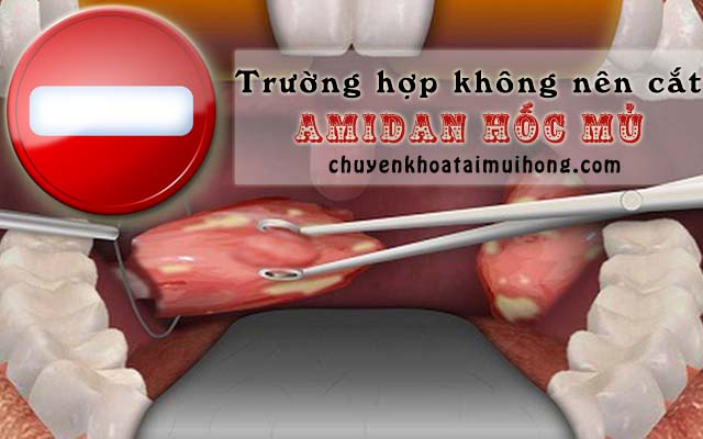 Trường hợp không nên cắt viêm amidan hốc mủ