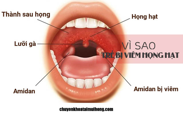 Vì sao trẻ bị viêm họng hạt?