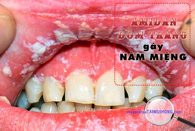 Amidan đốm trắng gây bệnh viêm họng