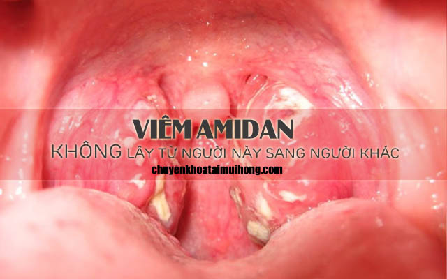 Bệnh viêm amidan không lây lan từ người sang người