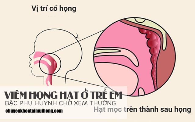 Bệnh viêm họng hạt ở trẻ em