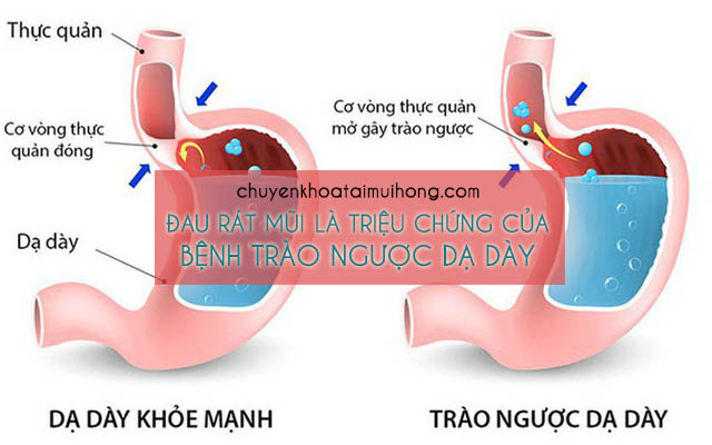 Đau rát mũi là triệu chứng của bệnh trào ngược dạ dày thực quản