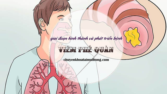 Các giai đoạn phát triển của bệnh viêm phế quản
