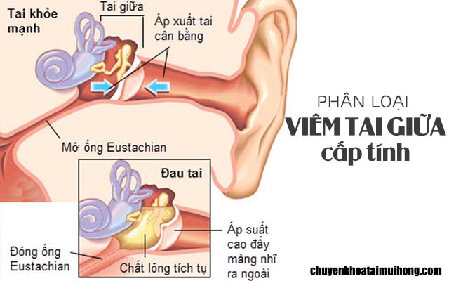 Phân loại bệnh viêm tai giữa cấp tính