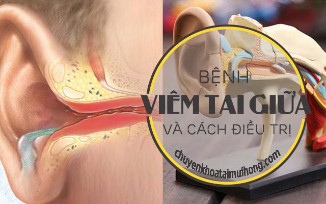  Bệnh viêm tai giữa và cách điều trị