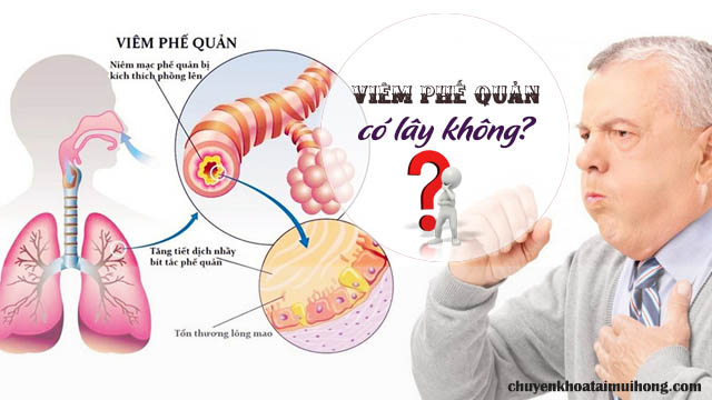 Viêm phế quản có lây không?