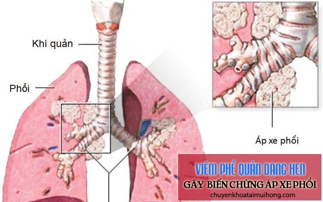 Viêm phế quản dạng hen gây biến chứng áp xe phổi