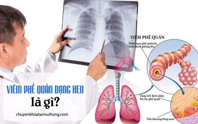 Viêm phế quản dạng hen là gì?