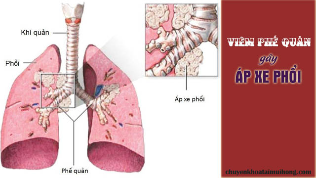 Viêm phế quản gây áp xe phổi