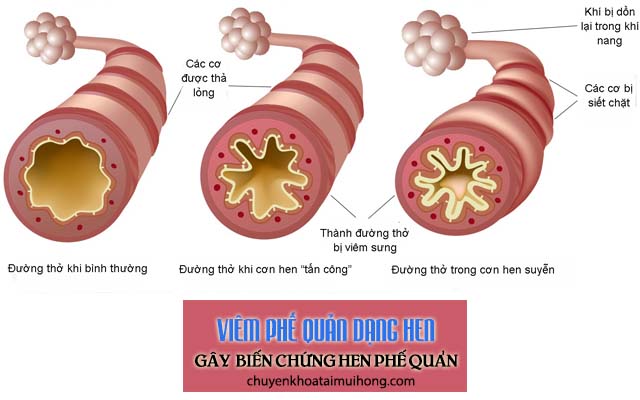 Viêm phế quản gây biến chứng hen phế quản