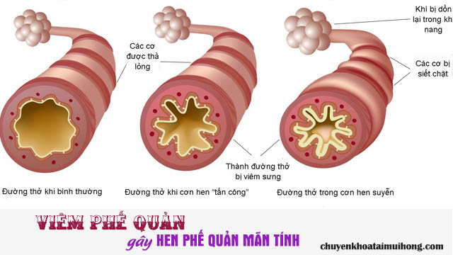 Viêm phế quản gây hen phế quản mãn tính