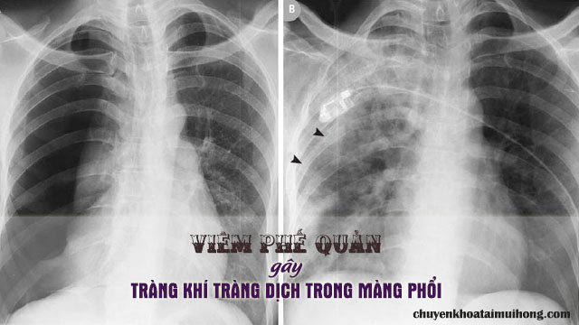 Viêm phế quản gây tràn khí tràng dịch vào trong màng phổi