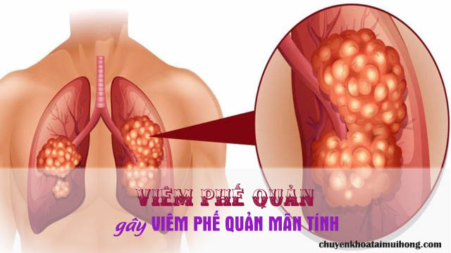 Viêm phế quản gây viêm phế quản mãn tính