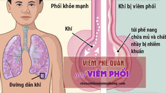 Viêm phế quản gây viêm phổi