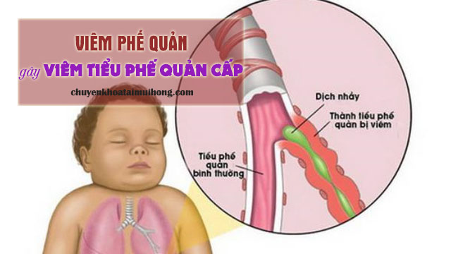 Viêm phế quản gây viêm tiểu phế quản cấp