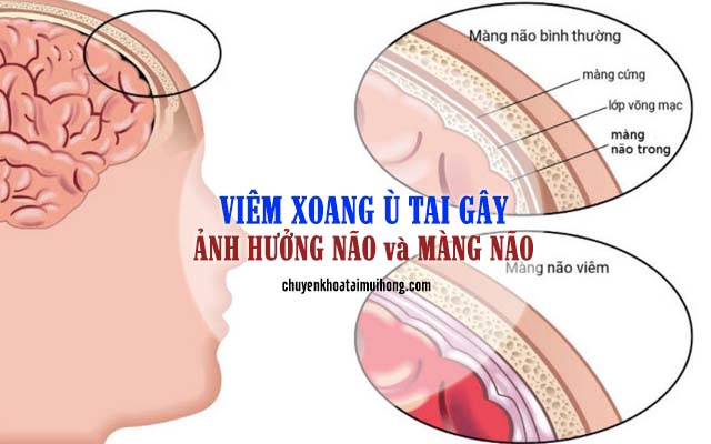 Viêm xoang ù tai gây ảnh hưởng tới não và màng não