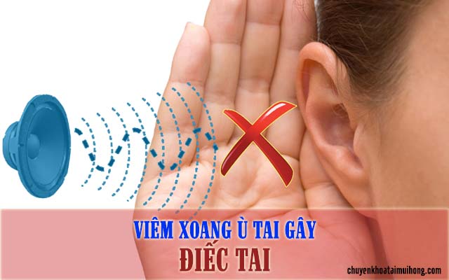 Viêm xoang ù tai gây điếc tai