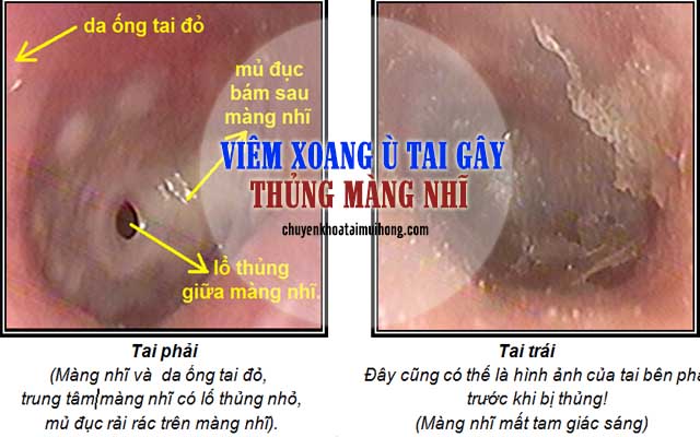 Viêm xoang ù tai gây thủng màn nhĩ 