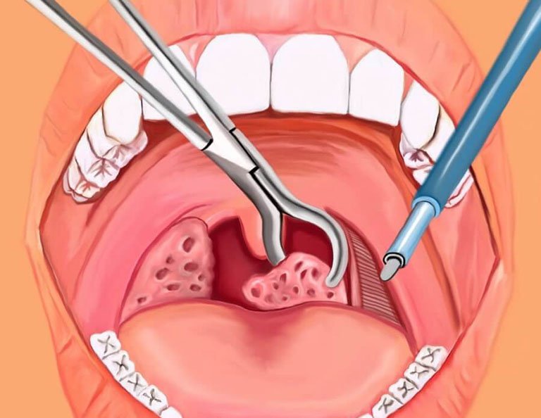 Trẻ em có nên cắt amidan khi bị viêm không là thắc mắc của nhiều bố mẹ