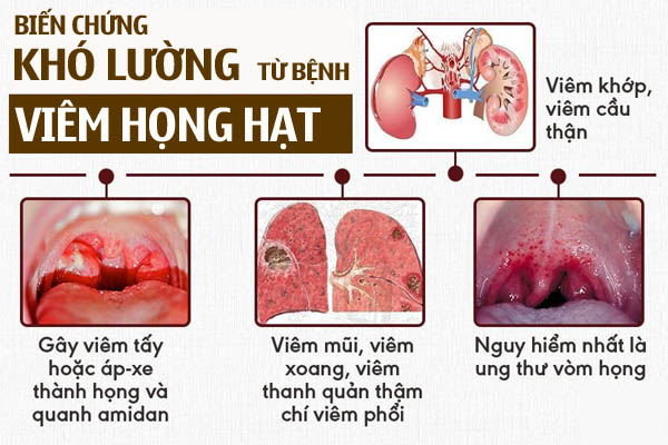 Biến chứng bệnh viêm họng hạt không thể coi thường