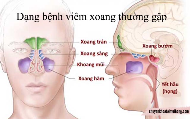 các dạng bệnh viêm xoang