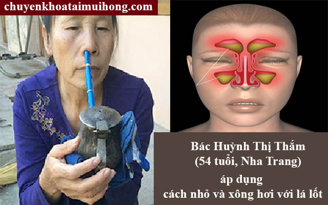 Trị viêm xoang bằng lá lốt hiệu quả không?