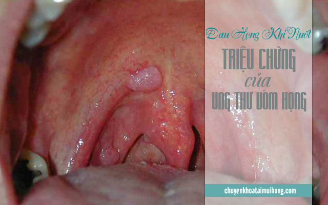 Đau họng khi nuốt do bệnh ung thư vòm họng