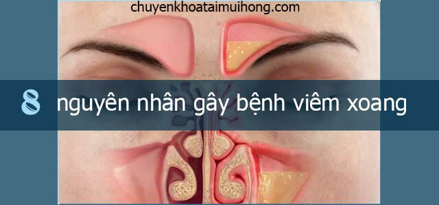 Nguyên nhân gây bệnh viêm xoang