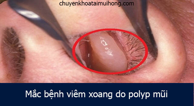 Nguyên nhân bị viêm xoang do polyp mũi