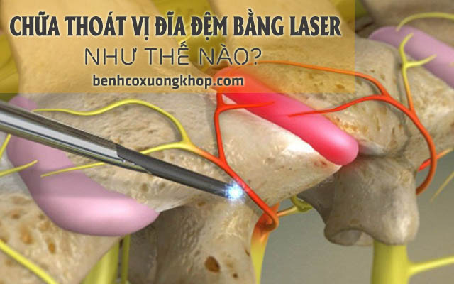 Chữa thoát vị đĩa đệm bằng laser như thế nào?