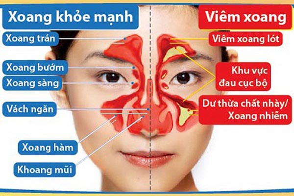 Bệnh viêm đa xoang gây nhiều triệu chứng khó chịu cho người bệnh Bệnh viêm đa xoang gây nhiều triệu chứng khó chịu cho người bệnh