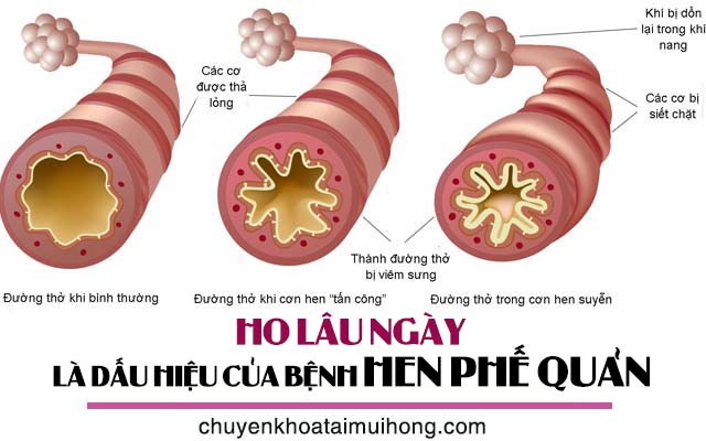 Ho lâu ngày là dấu hiệu bệnh hen phế quản