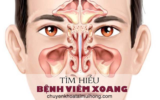 Tìm hiểu bệnh viêm xoang