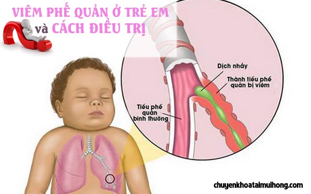 Viêm phế quản ở trẻ em và cách điều trị bệnh