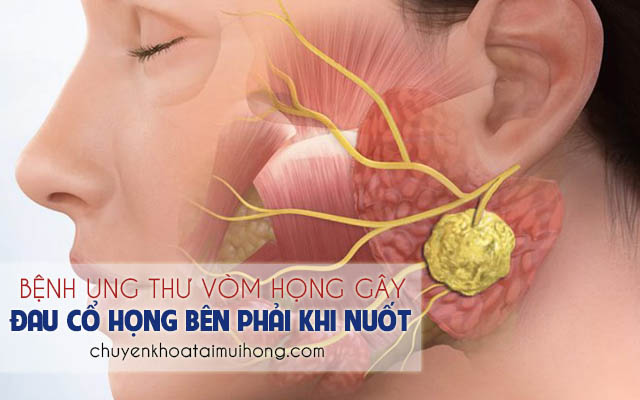 Đau họng bên phải khi nuốt là triệu chứng của bệnh ung thư vòm họng