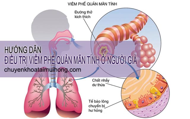 Cách điều trị viêm phế quản mãn tính ở người già