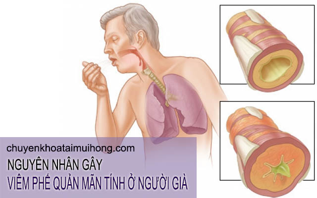 Nguyên nhân gây viêm phế quản mãn tính ở người già