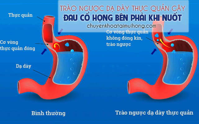 Trào ngược dạ dày thực quản gây đau họng bên phải khi nuốt