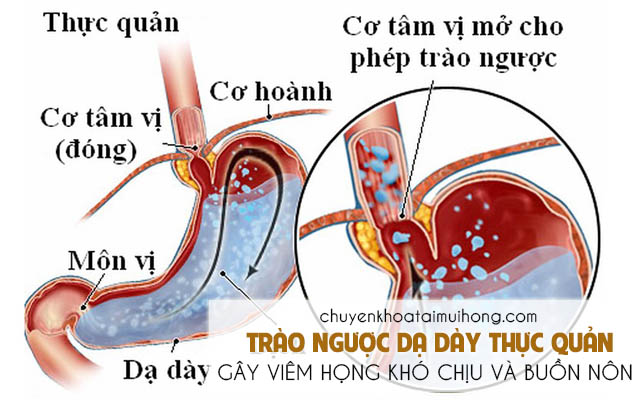 Viêm họng buồn nôn do các bệnh tiêu hóa