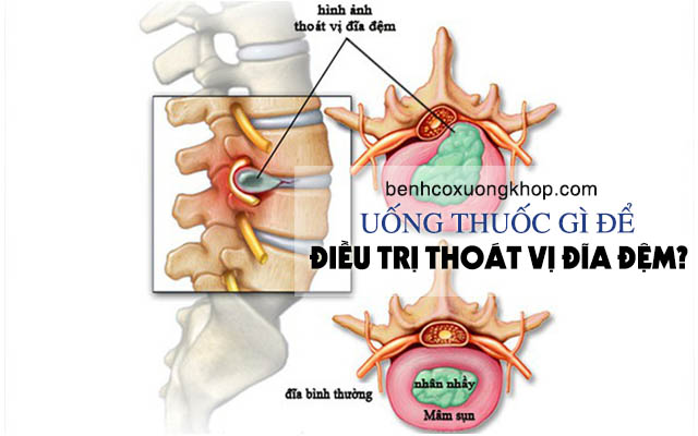 Bị thoát vị đĩa đệm nên uống thuốc gì để điều trị?