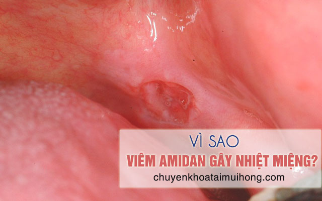 Vì sao viêm amidan gây nhiệt miệng?