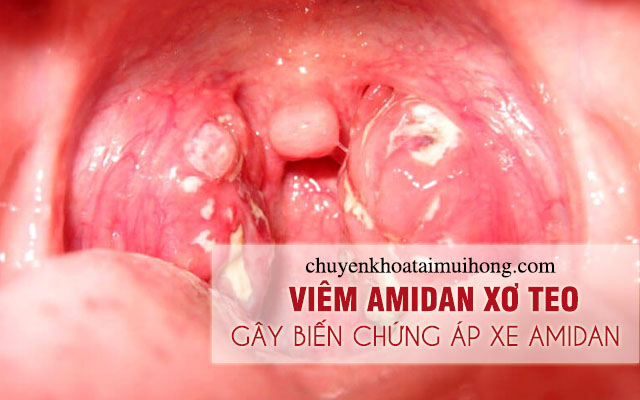 Viêm amidan xơ teo dẫn đến biến chứng áp xe amidan nguy hiểm