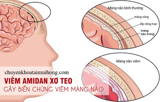 Viêm amidan xơ teo gây biến chứng viêm màng não 